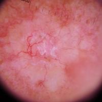 Dermoscopic appearance of previous…