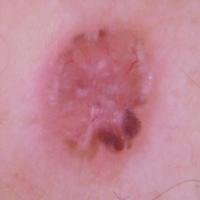 Same lesion - polarised modeMultiple shiny white…