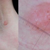 BCC - MAY globules