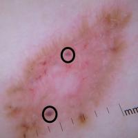 A solid BCCAnother relatively flat lesion; the…