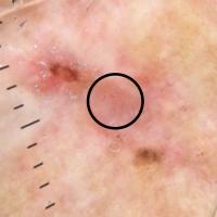 Dermoscopic appearance of previous figureSubtle…