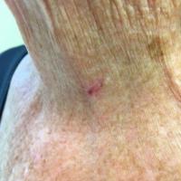 BCC can grow along skin creases giving a linear…