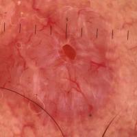 Dermoscopic appearance of previous…