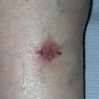 BCC shinThis lesion had grown slowly, was firm to…