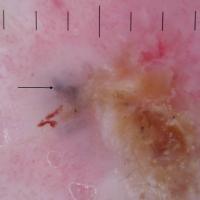 Dermoscopic appearance of previous figureArrow…