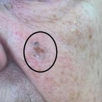 Basal cell carcinomaCopied with kind permission…
