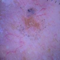 Dermoscopic appearance of previous…