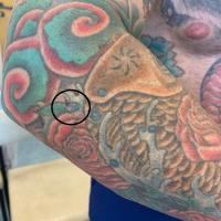 Basal cell carcinoma in a&nbsp;tattooTattoos…