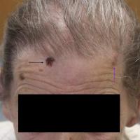 Multiple BCCMultiple BCC are common and patients…