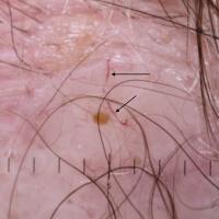 Same patient&nbsp;- right sided lesionGelatinous…