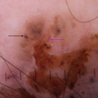 Dermoscopic appearance of previous figure - left…