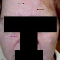 BCC and sebaceous gland hyperplasia (SGH)This…