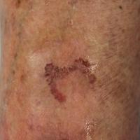 Superficial BCC on the shin - clinically the…