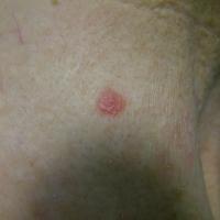 
	Superficial BCC - early lesion 
	
	Early…