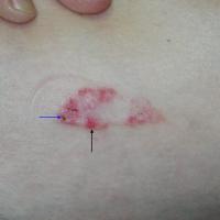 
	Superficial BCC on the trunk
	
	Erosions (black…
