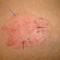 
	Superficial BCC on the trunk
	
	Erosions (black…