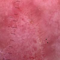 Superficial BCC - dermoscopic appearance of…