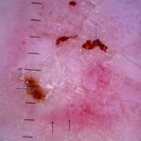 Superficial BCC - dermoscopic…
