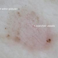 Dermoscopic appearance of previous figureDot…