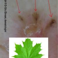 Superficial BCC - dermoscopic appearanceIrregular…