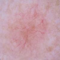 Superficial basal cell carcinoma - serpentine…