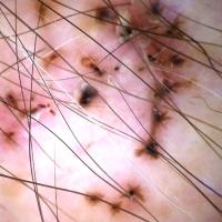 Dermoscopic appearance of previous…