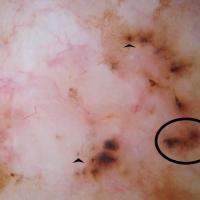 Dermoscopic appearance of previous figureDot…