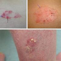 Superficial BCC (upper two images) and Bowen's…