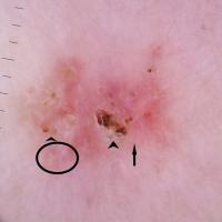 Dermoscopic appearance of previous figureErosions…