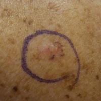 Superficial basal cell carcinoma