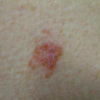 
	BCC -&nbsp;multicomponent
	
	Clinically this…