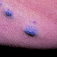 Blue Rubber Bleb Naevus syndrome
A type of…