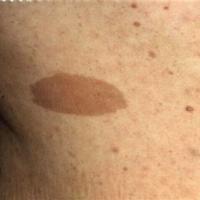 Cafe-au-lait patch