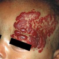 Infantile haemangioma - not present at…