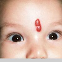 Infantile haemangioma - not present at…