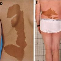 McCune Albright syndrome
Unusual looking areas…