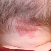 Stork bite -&nbsp;a type of capillary…