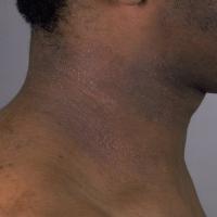 
	Atopic eczema with follicular prominence and…