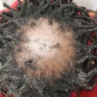 
	Central centrifugal cicatricial alopecia