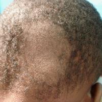
	Tinea capitis&nbsp;
