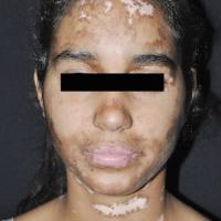 
	Vitiligo&nbsp;

	Copied with kind permission…