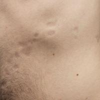
	Linear atrophoderma of Moulin