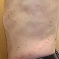 
	Blaschkitis - no cause identified