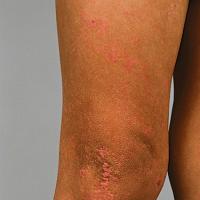 
	Focal dermal hypoplasia