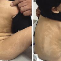 
	Hypomelanosis of Ito