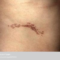 
	Linear lichen planus