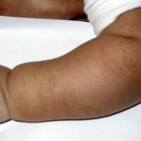 
	Linear and whorled naevoid hypermelanosis