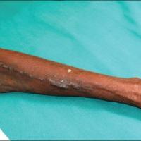 
	Linear psoriasis