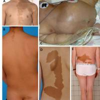 
	McCune-Albright syndrome