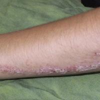 
	Inflamed linear verrucous epidermal naevus